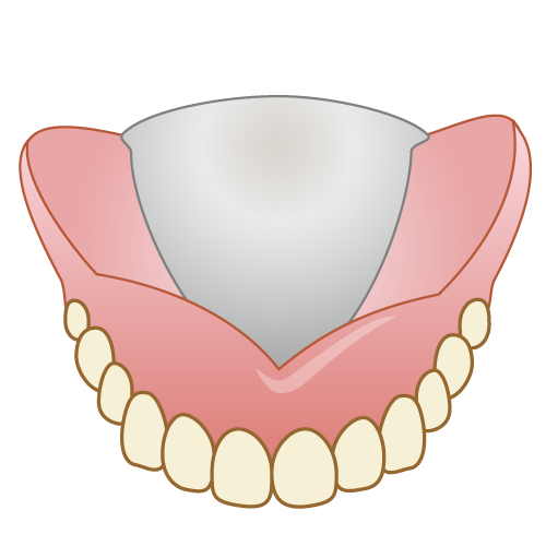 金属床総入れ歯