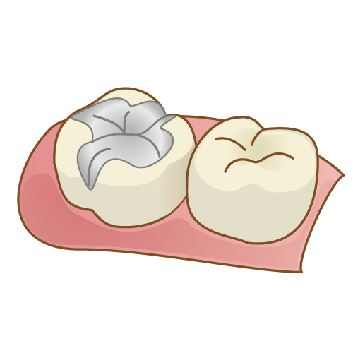 銀歯（保険適応）