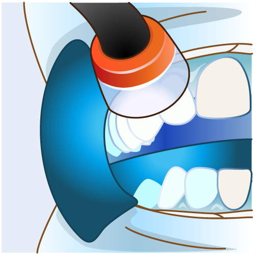 ホワイトニング(上下28歯分)
